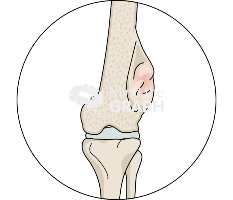 Osteosarcoma inside zoom Icons, Symbols, Pictures, and Images