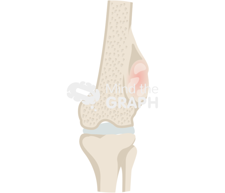 Osteosarcoma inside zoom Icons, Symbols, Pictures, and Images