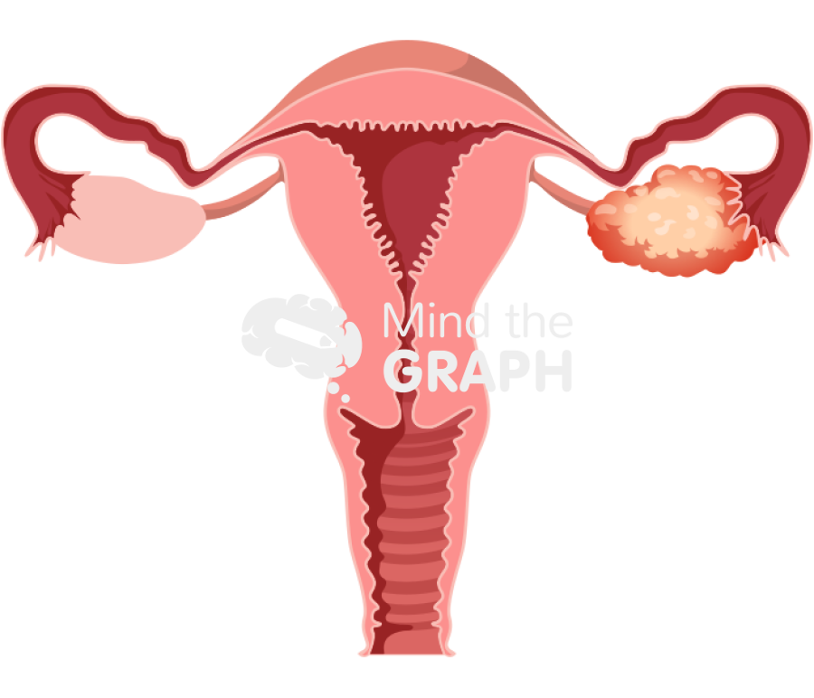 Ovarian cancer front cut Icons, Symbols, Pictures, and Images