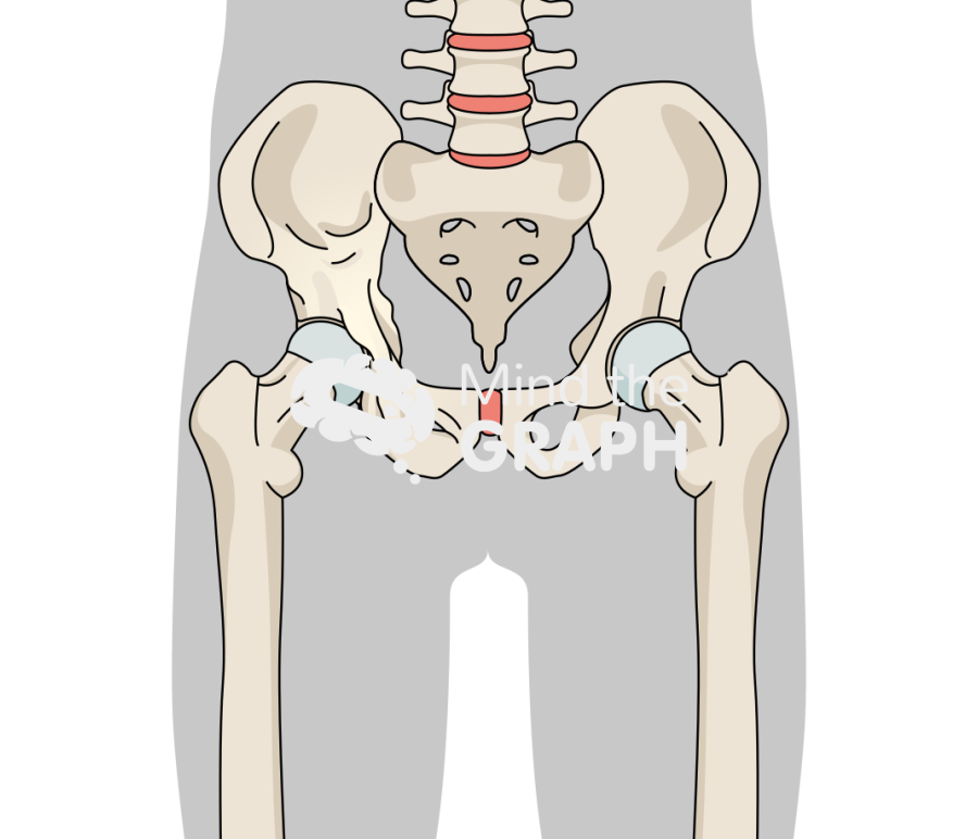 Pagets disease hip arthritis body Icons, Symbols, Pictures, and Images