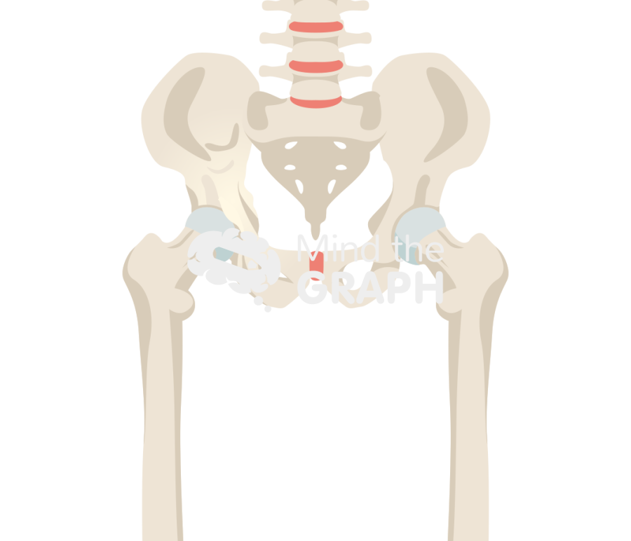 Pagets disease hip arthritis bone full Icons, Symbols, Pictures, and Images