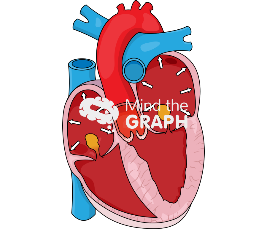 Paradoxical low flow low gradient severe aortic stenosis Icons, Symbols, Pictures, and Images