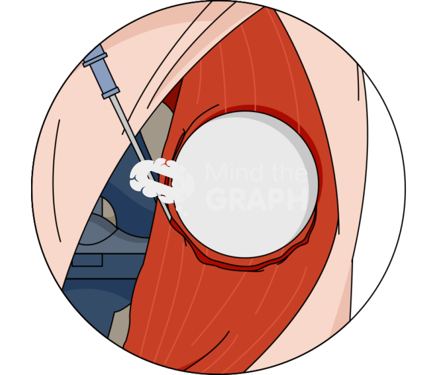 Patella denervation zoom Icons, Symbols, Pictures, and Images