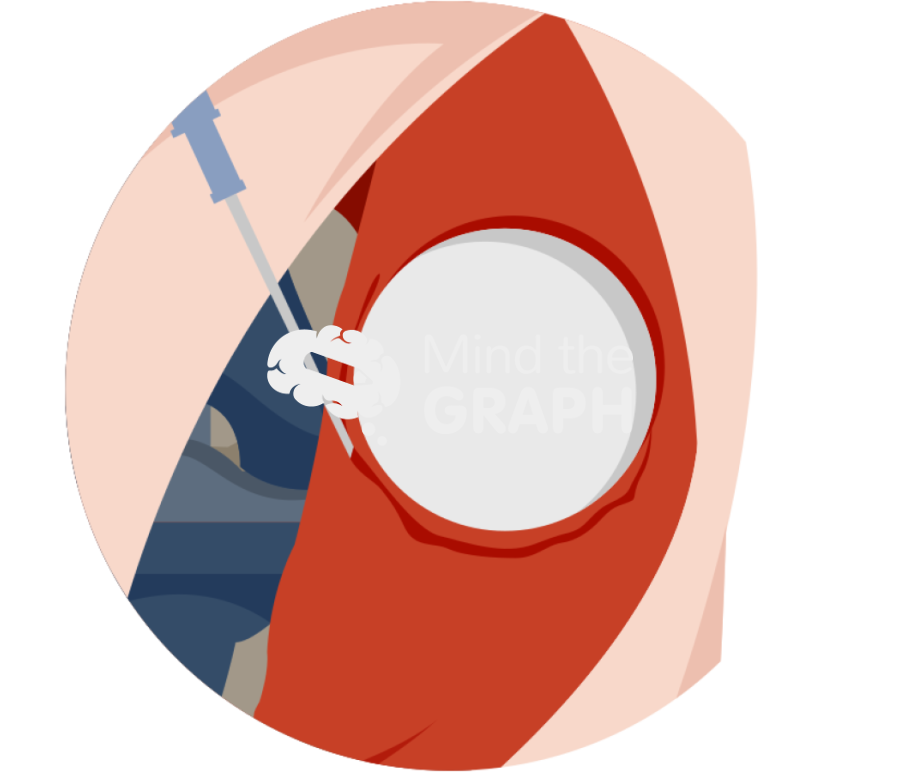 Patella denervation zoom Icons, Symbols, Pictures, and Images