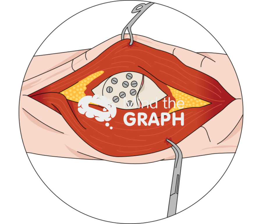 Patella rebar screws intraop zoom Icons, Symbols, Pictures, and Images