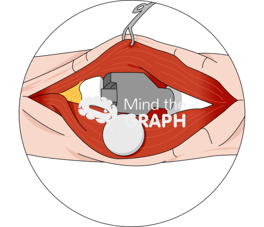 Patella rebar screws with patella zoom Icons, Symbols, Pictures, and Images