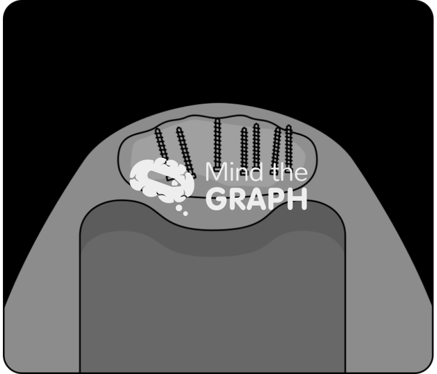 Patella rebar screws x ray Icons, Symbols, Pictures, and Images