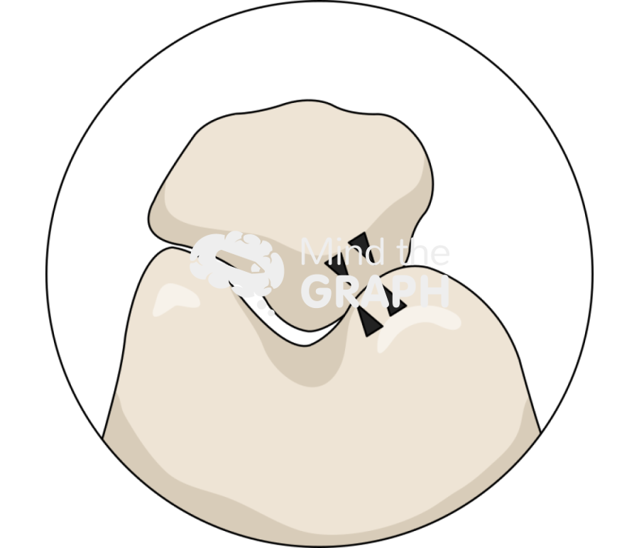 Patellofemoral arthritis classificiation stage3 zoom Icons, Symbols, Pictures, and Images