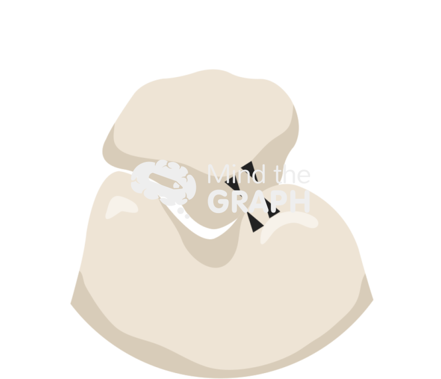 Patellofemoral arthritis classificiation stage3 zoom Icons, Symbols, Pictures, and Images