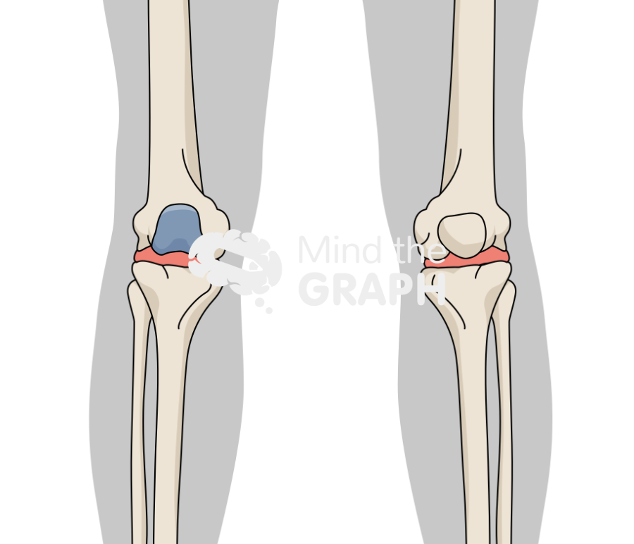 Patellofemoral joint knee arthroplasty inlay body Icons, Symbols, Pictures, and Images