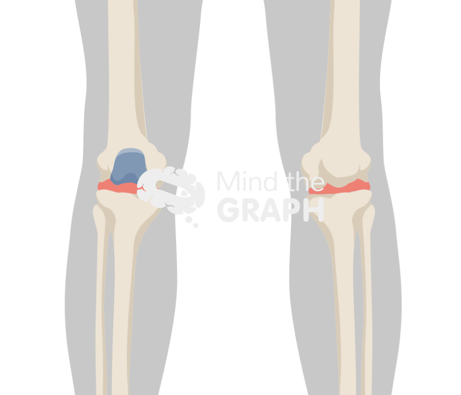 Patellofemoral joint knee arthroplasty inlay body Icons, Symbols, Pictures, and Images