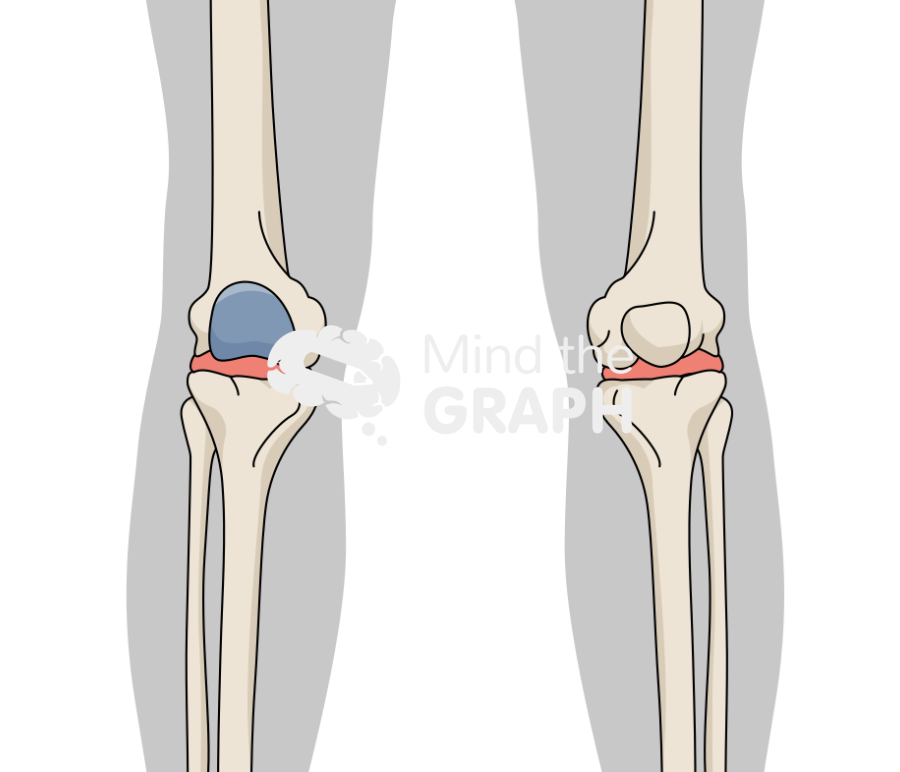 Patellofemoral joint knee arthroplasty onlay body Icons, Symbols, Pictures, and Images