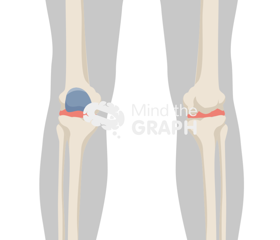 Patellofemoral joint knee arthroplasty onlay body Icons, Symbols, Pictures, and Images
