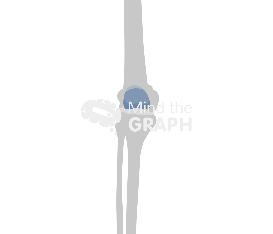 Patellofemoral joint knee arthroplasty onlay bone Icons, Symbols, Pictures, and Images