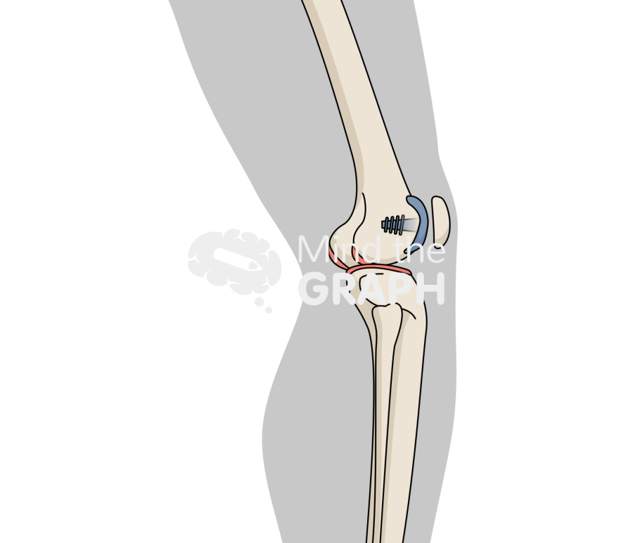 Patellofemoral joint knee lateral inlay body Icons, Symbols, Pictures, and Images