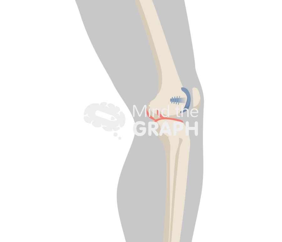 Patellofemoral joint knee lateral inlay body Icons, Symbols, Pictures, and Images