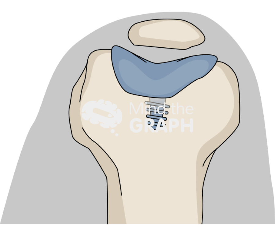 Patellofemoral joint knee sunrise inlay Icons, Symbols, Pictures, and Images
