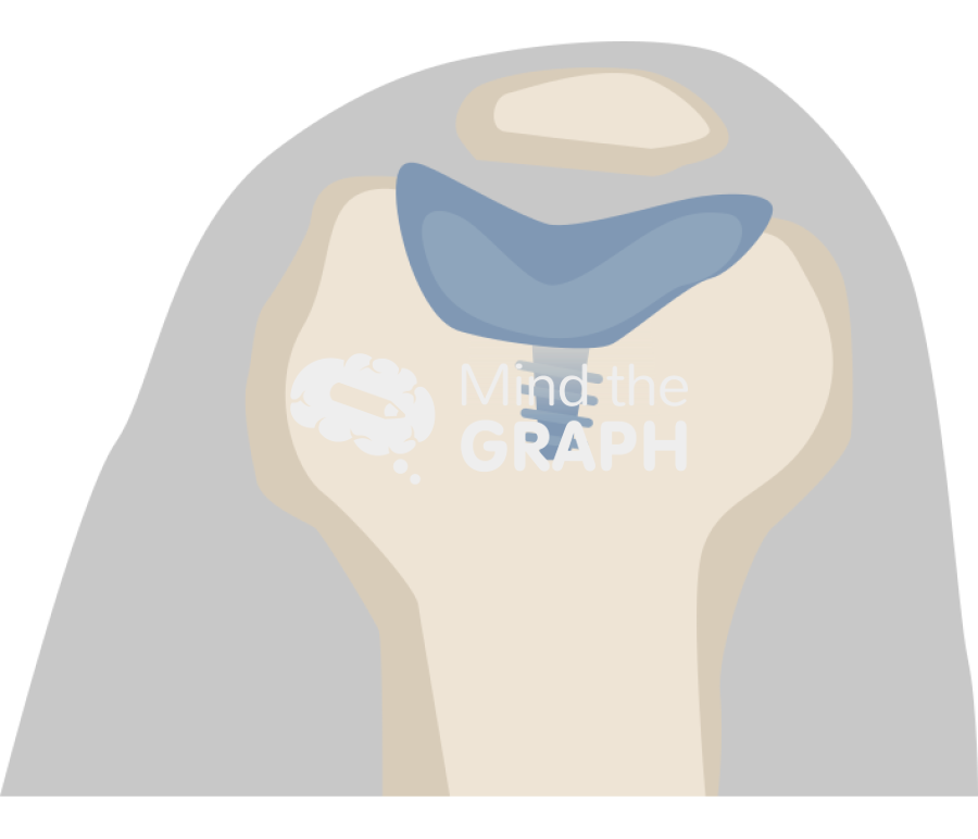 Patellofemoral joint knee sunrise inlay Icons, Symbols, Pictures, and Images