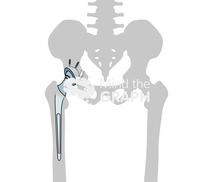Pelvic discontinuity bone Icons, Symbols, Pictures, and Images
