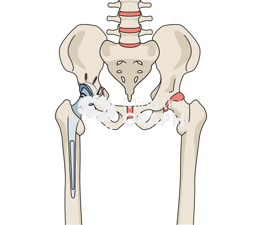 Pelvic discontinuity bone full Icons, Symbols, Pictures, and Images