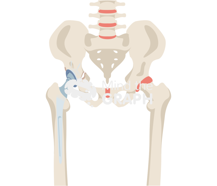 Pelvic discontinuity bone full Icons, Symbols, Pictures, and Images
