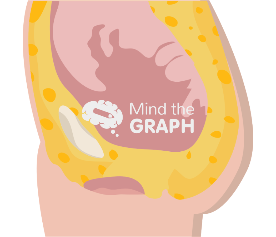 Pelvic exenteration surgery lateral cut Icons, Symbols, Pictures, and Images