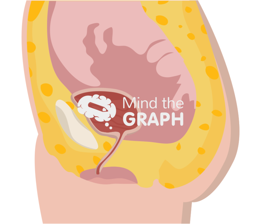 Pelvic exenteration surgery preserves baldder lateral cut Icons, Symbols, Pictures, and Images