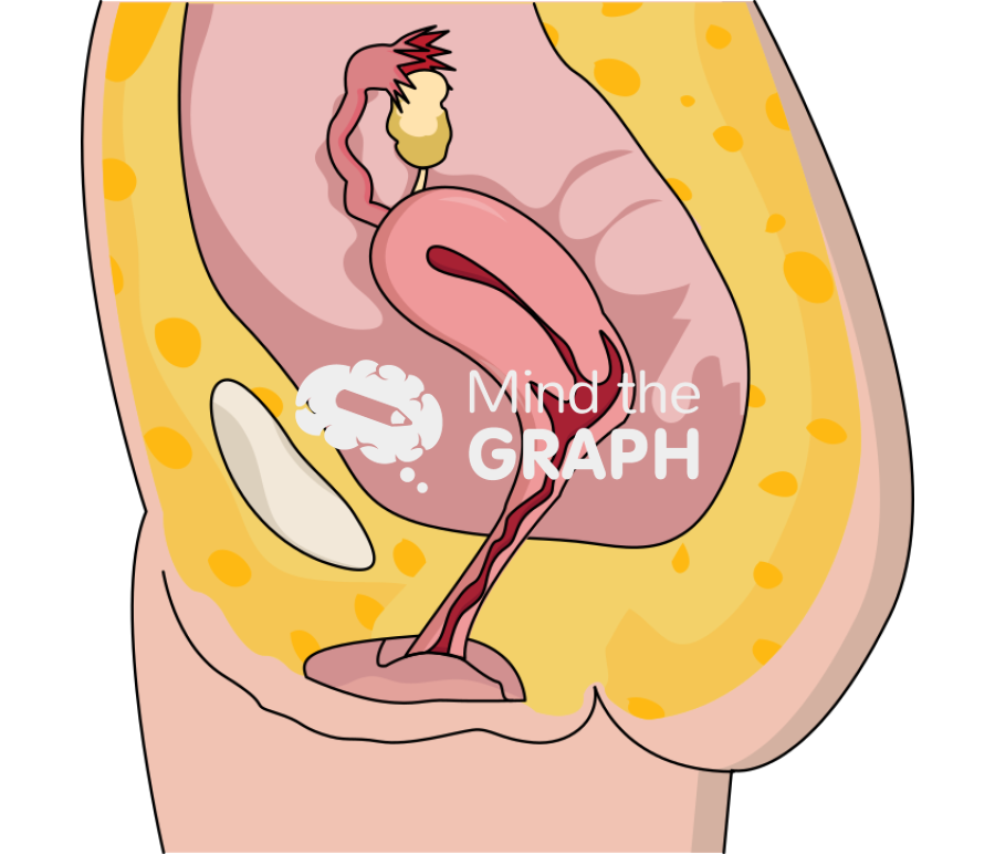 Pelvic exenteration surgery preserves uterus lateral cut Icons, Symbols, Pictures, and Images