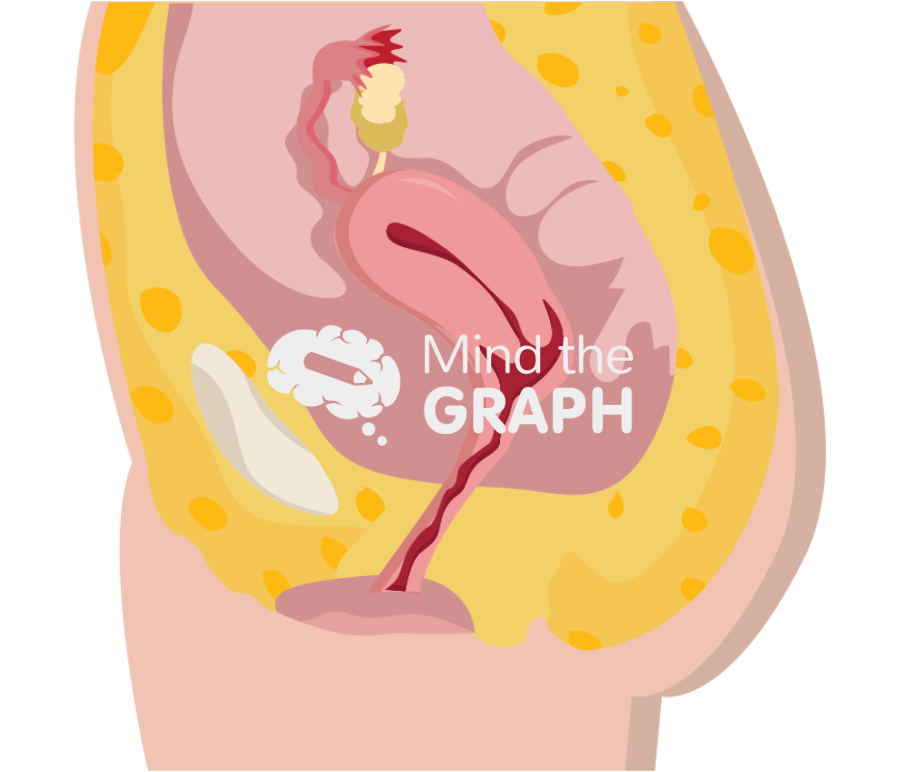 Pelvic exenteration surgery preserves uterus lateral cut Icons, Symbols, Pictures, and Images