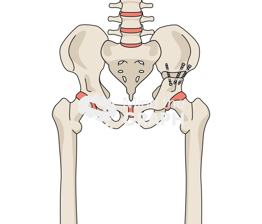 Pelvic osteotomy bone full Icons, Symbols, Pictures, and Images