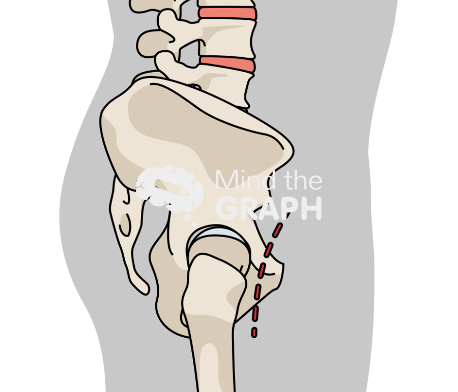 Pelvic skeleton sagittal anterior hip arthroplasty Icons, Symbols, Pictures, and Images