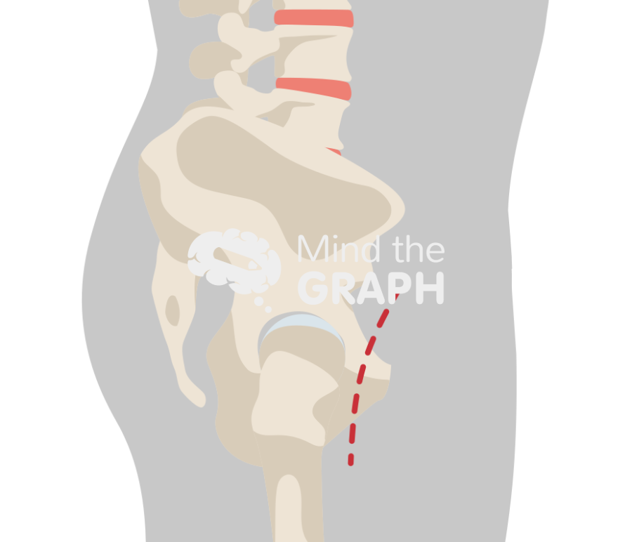 Pelvic skeleton sagittal anterior hip arthroplasty Icons, Symbols, Pictures, and Images