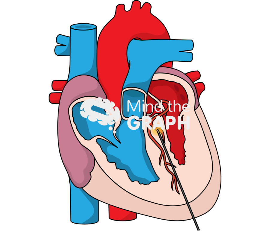 Percutaneous intramyocardial septal radiofrequency ablation Icons, Symbols, Pictures, and Images