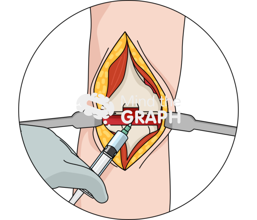 Periarticular total knee arthroplasty tka injection zoom Icons, Symbols, Pictures, and Images