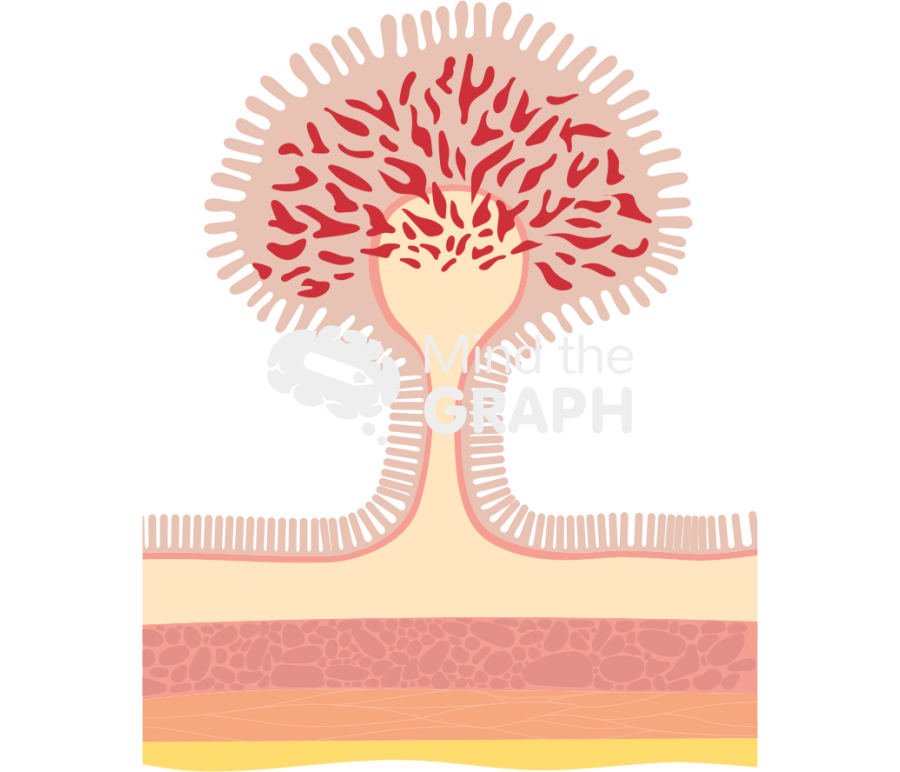 Polyp haggitt pedunculated adenoma Icons, Symbols, Pictures, and Images