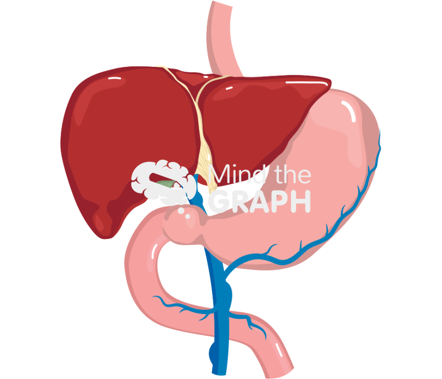 Portal hypertension Icons, Symbols, Pictures, and Images