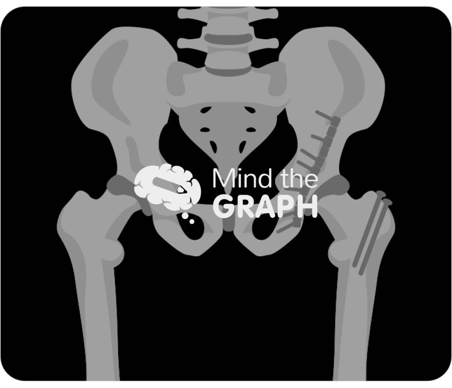 Post traumatic hip arthritis column fixation x ray Icons, Symbols, Pictures, and Images