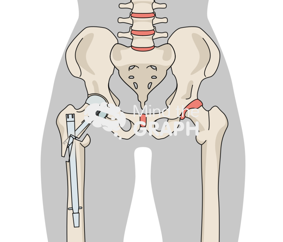 Post traumatic hip arthritis nail body Icons, Symbols, Pictures, and Images