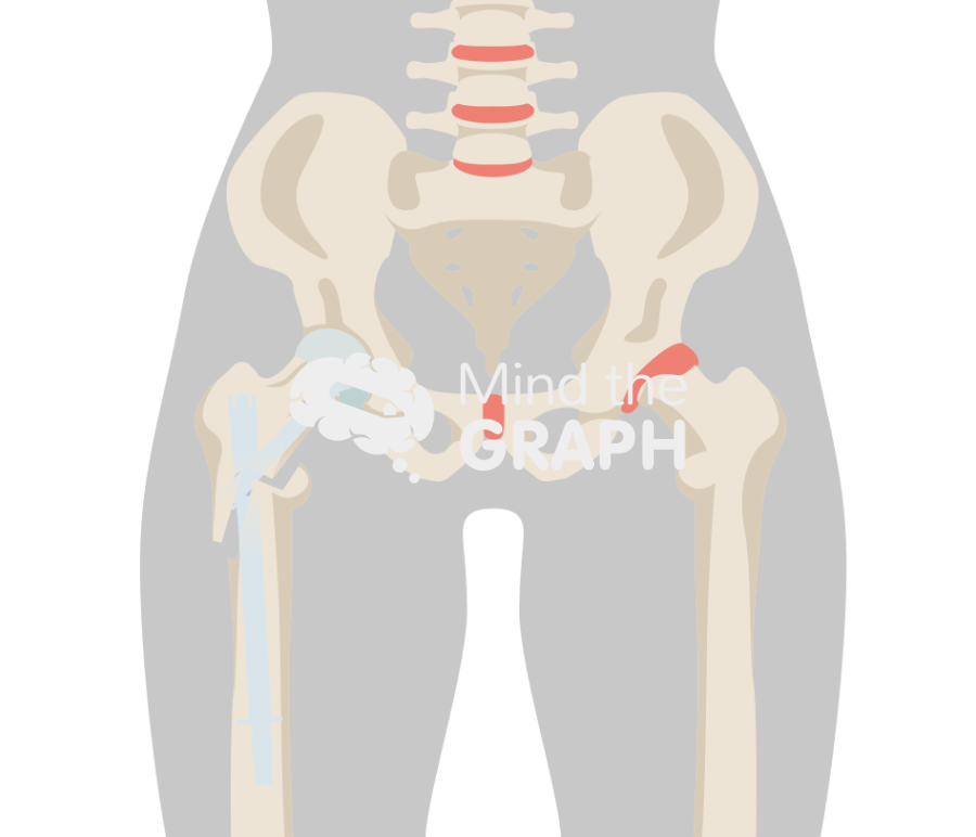 Post traumatic hip arthritis nail body Icons, Symbols, Pictures, and Images