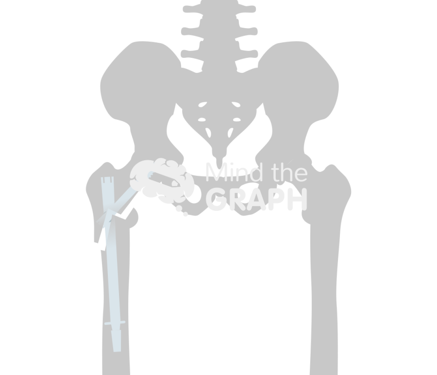 Post traumatic hip arthritis nail bone Icons, Symbols, Pictures, and Images