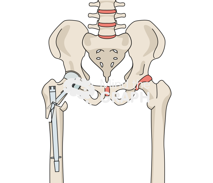 Post traumatic hip arthritis nail bone full Icons, Symbols, Pictures, and Images