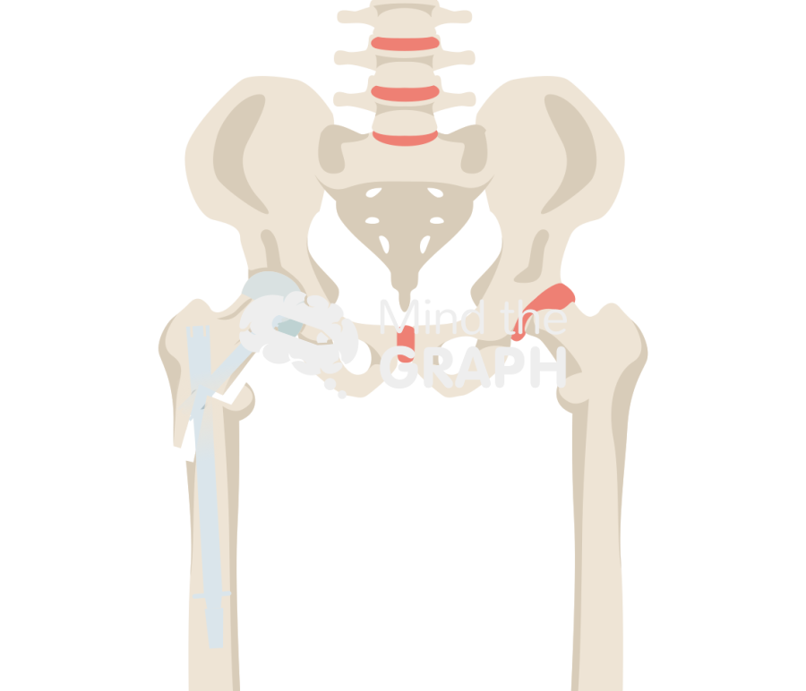 Post traumatic hip arthritis nail bone full Icons, Symbols, Pictures, and Images