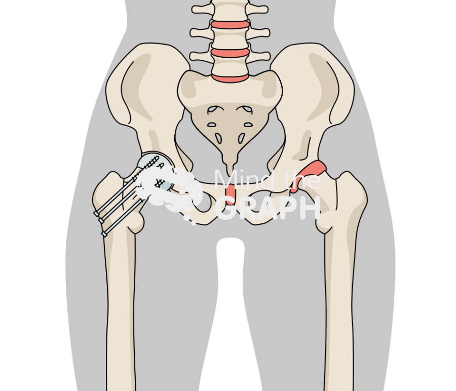 Post traumatic hip osteoarthritis screws body Icons, Symbols, Pictures, and Images