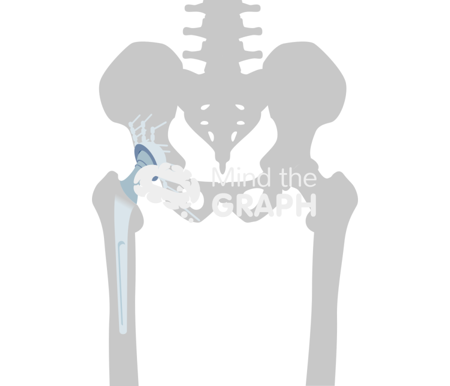 Post traumatic hip total hip arthroplasty bone Icons, Symbols, Pictures, and Images