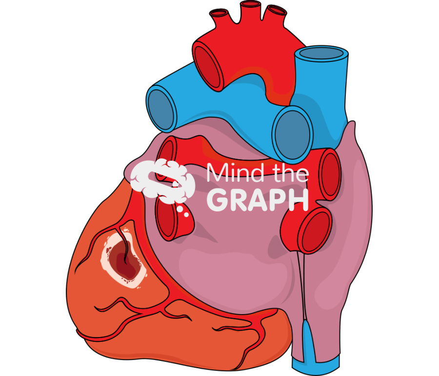 Posterobasal infarct Icons, Symbols, Pictures, and Images