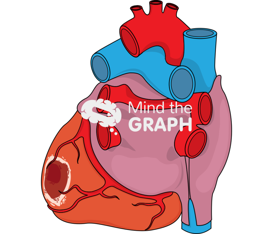Posterolateral infarct Icons, Symbols, Pictures, and Images