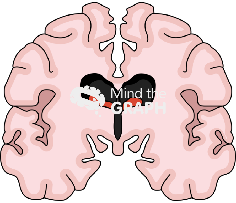 Posthemorrhagic ventricular dilatation preterm infant Icons, Symbols, Pictures, and Images