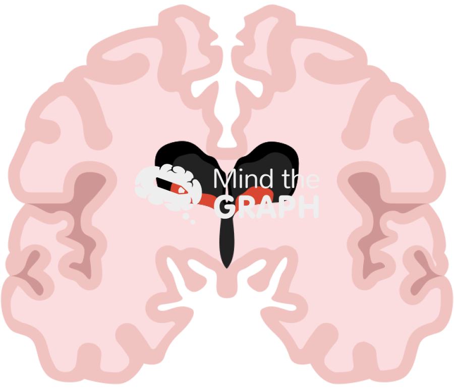 Posthemorrhagic ventricular dilatation preterm infant Icons, Symbols, Pictures, and Images