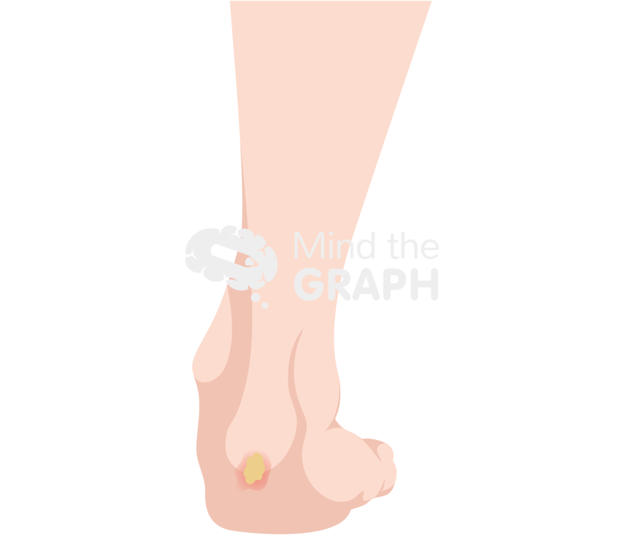 Pressure ulcer stages 1 Icons, Symbols, Pictures, and Images