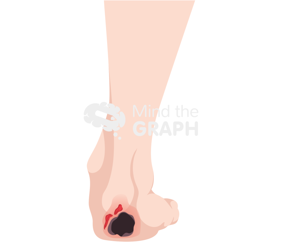 Pressure ulcer stages 2 Icons, Symbols, Pictures, and Images